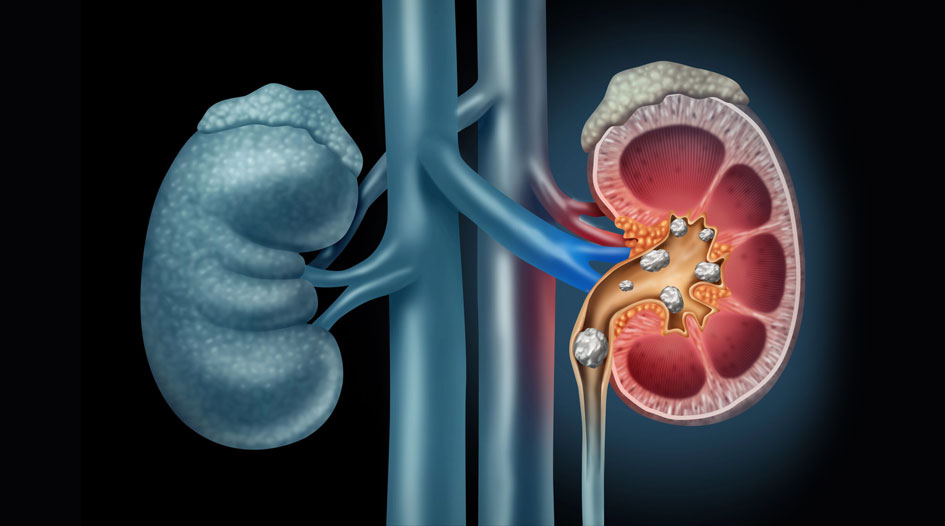 Diabetic Kidney Disease